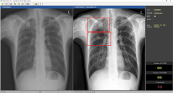 Tuberculosis